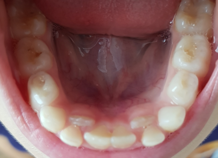 2018 год - прорезываются коренные зубы