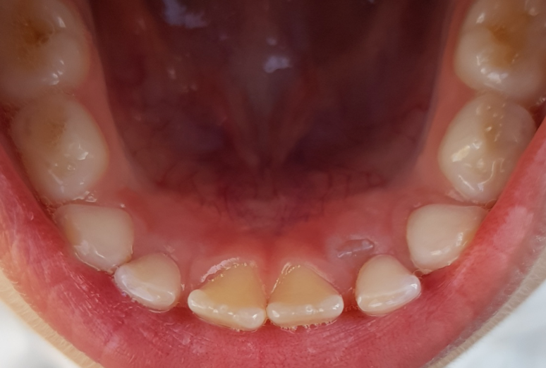 2018 год - прорезываются коренные зубы